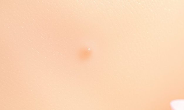 Wysyp po retinolu: jak działa, dla kogo i jak używać